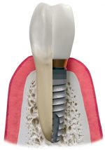 Dental Implants in Iran