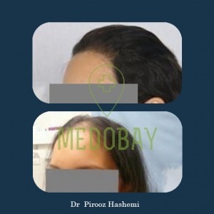 Dr Parisa Zandi Female Hair Transplant Before After Picture