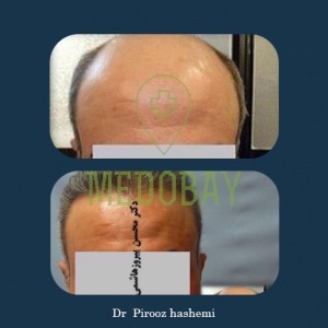 Gandi Hospital Tasvir Javani Hair Transplant Before and After Picture