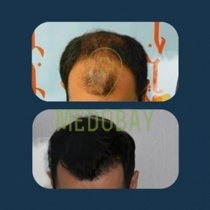 Gandi Hospital Tasvir Javani Hair Transplant Before and After Picture