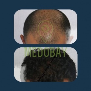 Gandi Hospital Tasvir Javani Hair Transplant Before and After Picture