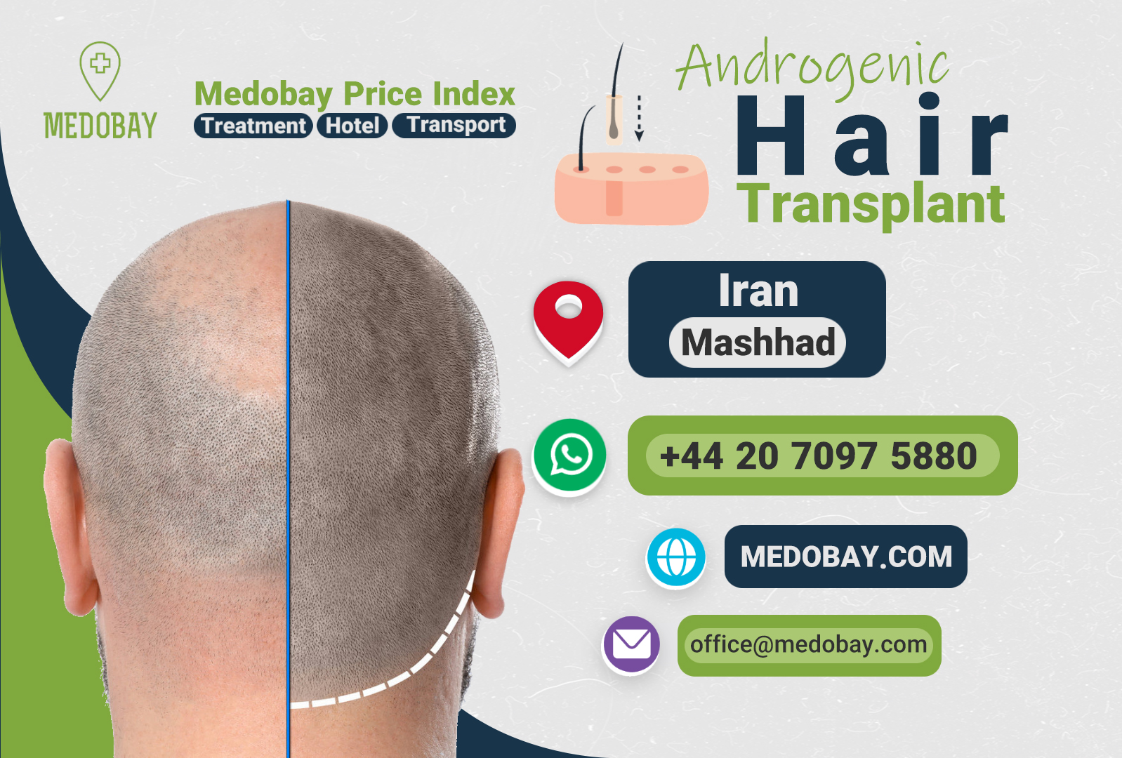 Androgenic Hair Transplant Mashhad