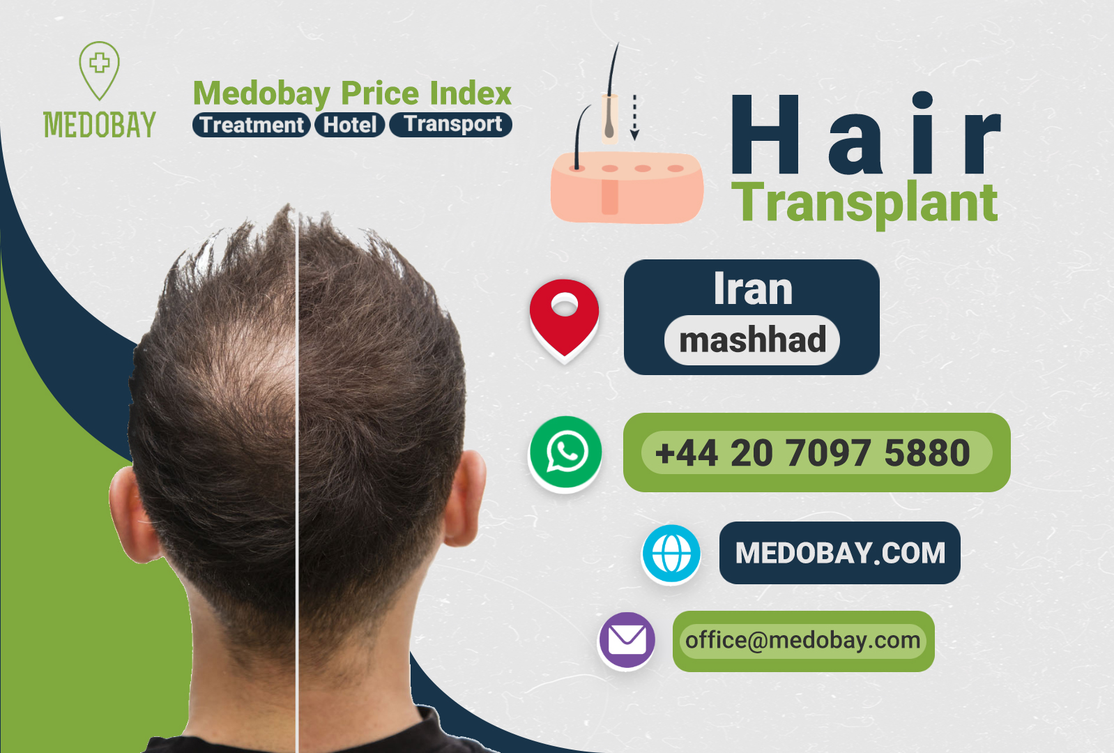 Hair Transplant Mashhad