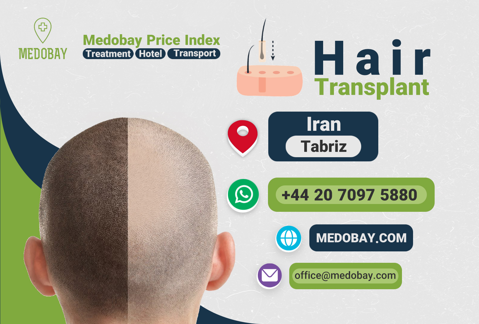 Hair Transplant Tabriz